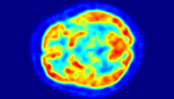 A powerful new deep learning algorithm has been developed that can study PET scan images and effectively detect the onset of #Alzheimer's disease up to six years earlier than current diagnostic methods ow.ly/M6tW30mxVP6