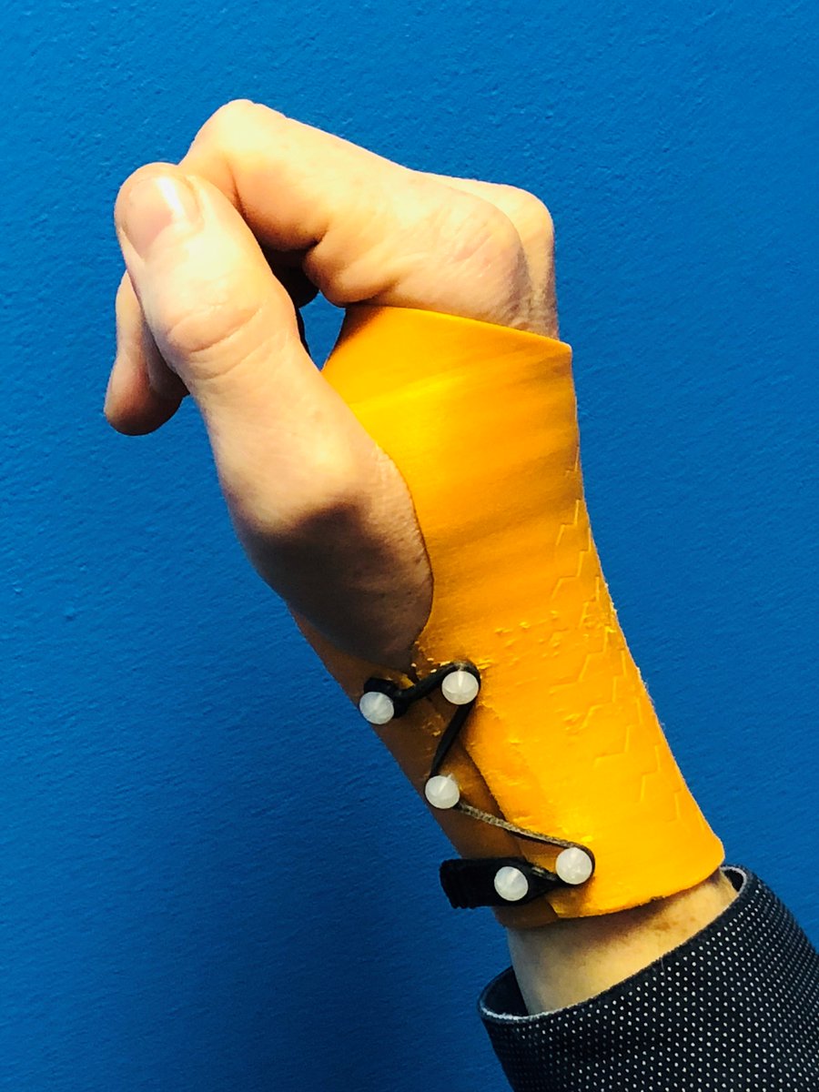 PDR_SPD's tweet image. We've been working with Marc Lloyd, a leading Burns &amp;amp; Plastics Physio @ABMhealth. He's presenting '#3Dprinting and its role in hand therapy at @BAHTHandtherapy conference ttps://www.hand-therapy.co.uk/annual_conference/conference_programme.aspx on Sat.