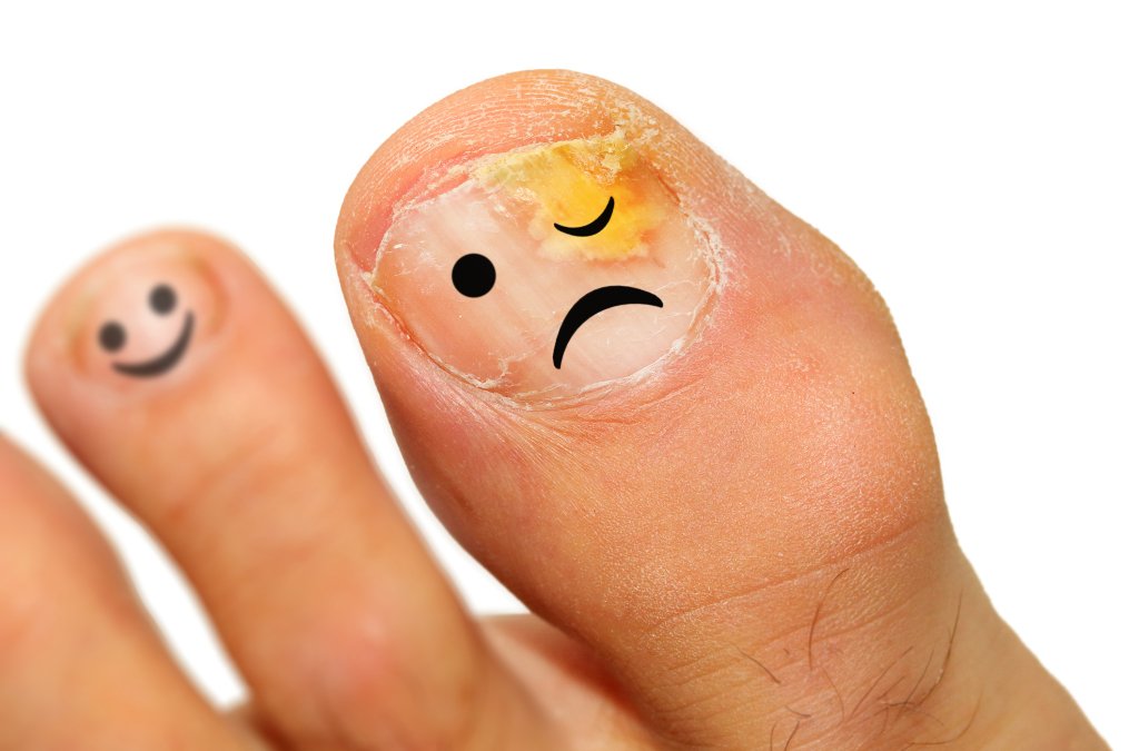 Fungal nail infection, gross right! Well did you know you can get rid of it?...This week's blog is all about keeping your tootsies healthy and fungus free! #skinandshit #feet #fungalnailinfection #fungaltreatment #toes #fungaladvice skinandshit.co.uk/2018/11/09/fun…