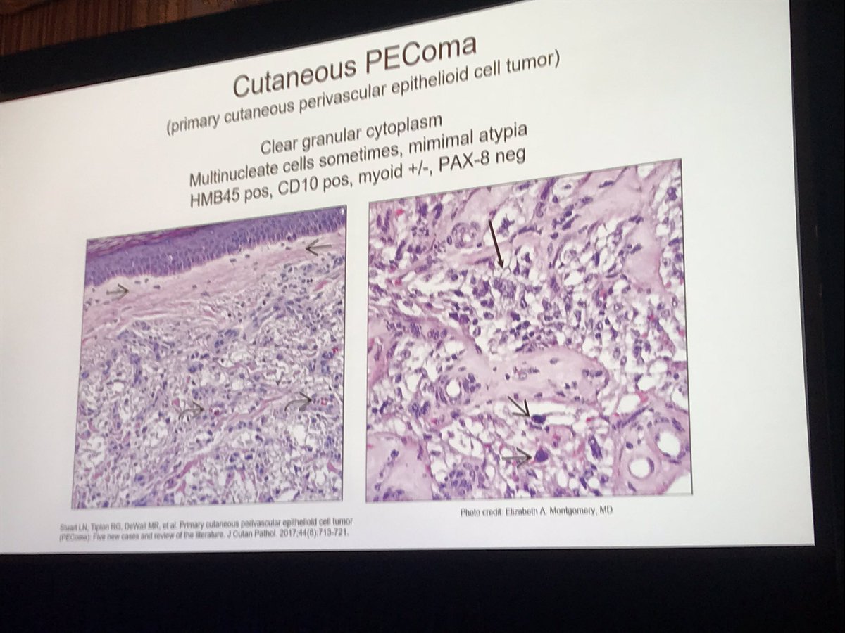 Jerad Gardner, MD (@jmgardnermd) on Twitter photo Thx for citing our cutaneous PEComa paper <a href="/BethRubenMD/">Beth S. Ruben, MD</a>! #ASDP18 self assessment. ncbi.nlm.nih.gov/m/pubmed/28556… #dermpath #dermatology #pathology #bstpath <a href="/DrLaurenStuart/">Lauren Stuart MD,MBA</a> <a href="/Dr_MikeDeWall/">Mike DeWall, D.O.</a> <a href="/AnnieMorrisonMD/">Annie O. Morrison MD</a> Thx for citing our cutaneous PEComa paper <a href="/BethRubenMD/">Beth S. Ruben, MD</a>! #ASDP18 self assessment. ncbi.nlm.nih.gov/m/pubmed/28556… #dermpath #dermatology #pathology #bstpath <a href="/DrLaurenStuart/">Lauren Stuart MD,MBA</a> <a href="/Dr_MikeDeWall/">Mike DeWall, D.O.</a> <a href="/AnnieMorrisonMD/">Annie O. Morrison MD</a>