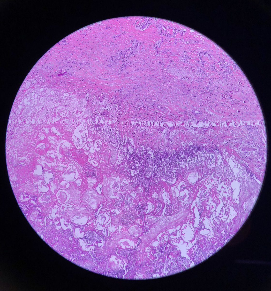 redsnapperpath's tweet photo. My 2 favourite specialities - #beautiful #pancreatic #fatnecrosis in the 2018 #slidelibrary #ASDP18 #GIPath #DermPath @ASDPTweets π€ π¬ https://t.co/ZFPYZnTCgK
