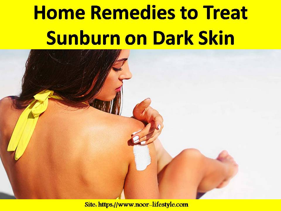 urlivelife's tweet photo. Home Remedies to #TreatSunburn on #DarkSkin https://t.co/sHDCSwToOj https://t.co/VFThYeq6ty