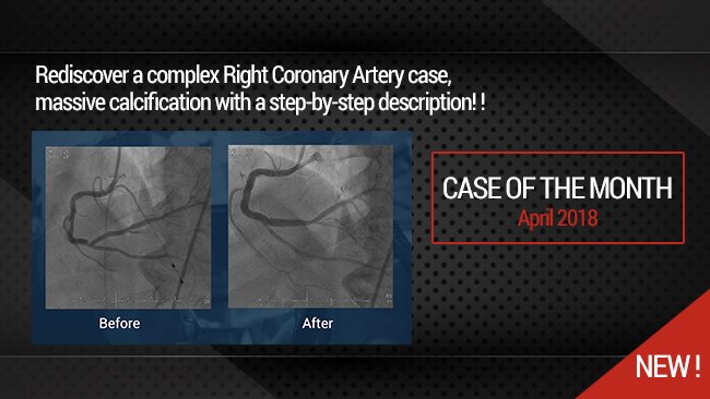 EMJIntervention's tweet photo. #EMJblog - RCA with massive calcification. #IntCard #Cardiology #MedEd #Health https://t.co/HqFOlMRlgM https://t.co/UoXgqarn0P