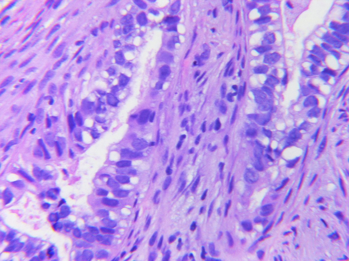 Fetal variant of pulmonary ADC is characterized by acini lined by cells exhibiting subnuclear (mostly) and also supranuclear glycogen rich vacuoles similar in appearance to the pseudoglandular phase of embryonic lung development. Can be low or high grade (HG); this example is HG