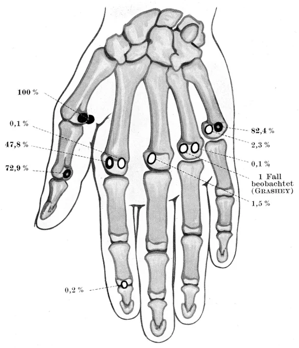人によって数が異なる種子骨とその発現頻度。発生する場所には概ね腱が存在する。成長過程で骨の一部が分離して生じた説と、腱の中に生じた説があるが、膝蓋骨(人体最大の種子骨)の研究では前者とする報告がある。 