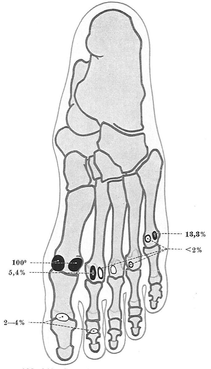 人によって数が異なる種子骨とその発現頻度。発生する場所には概ね腱が存在する。成長過程で骨の一部が分離して生じた説と、腱の中に生じた説があるが、膝蓋骨(人体最大の種子骨)の研究では前者とする報告がある。 
