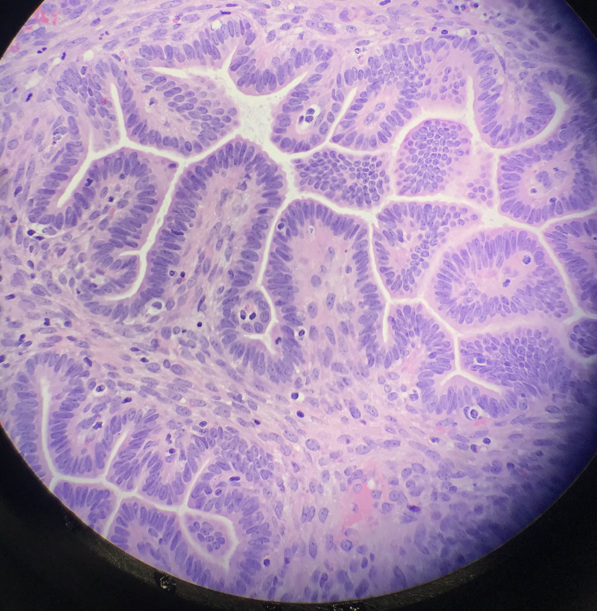 30 yo 🚺 on provera; with menorrhagia. Yep, Provera ain’t gonna help with this li’l guy.