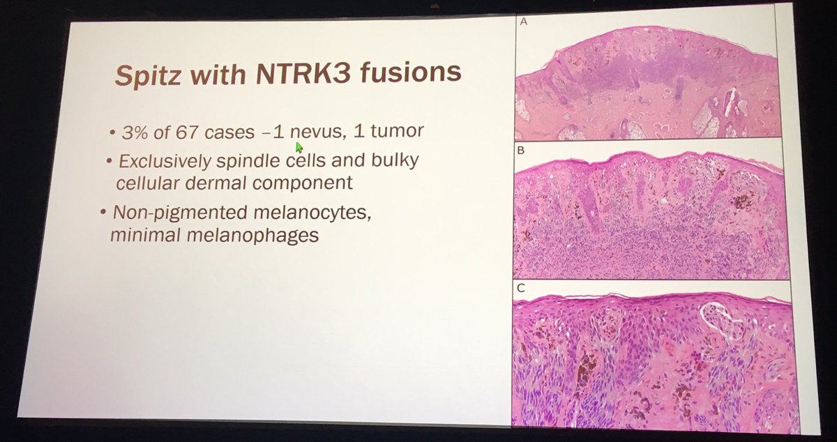 Dermpathl's tweet photo. Table comparing NTRK3-fused vs. non-NTRK3-fused PSCN of Reed. NTRK3 fusions were also found in 2 Spitz nevi (with a spindled &amp; pigmented phenotype). Dr Gerami concluded that fusions are the likely driver for Reed nevi and that they are related to Spitz nevi with overlap #ASDP18 https://t.co/jmIDo9YoaV