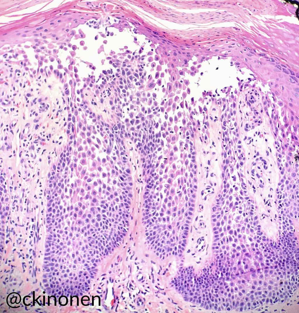 Hailey-Hailey disease with the so-called dilapidated brick wall. ATP2C1 mutation. Intertriginous bullae. Intraepidermal acantholysis. Clinical correlation to differentiate from other acantholytic dermatoses. #dermpath #pathogy #dermatology