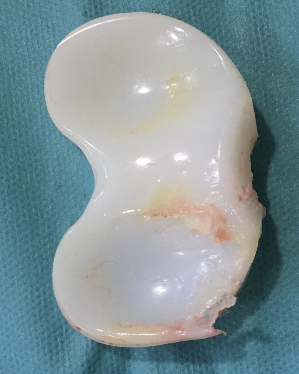 DrAdrianBarrera's tweet photo. Una de las principales causas de #aflojamiento #aséptico y #revisión #articular es la colocación inadecuada de #prótesis de #rodilla produce desgaste prematuro y liberación de partículas con respuesta inflamatoria y #osteolisis. https://t.co/LjkqSoe5rs @ClinicaCEMTRO @ICJRortho https://t.co/pf2W3AywuW