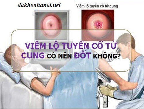 Lynvaz01's tweet photo. Tác d��ng phụ của đốt điện trong điều trị viêm lộ tuyến tử cung? https://t.co/bGD2WAF3FE https://t.co/Cj2gsrJRe6
