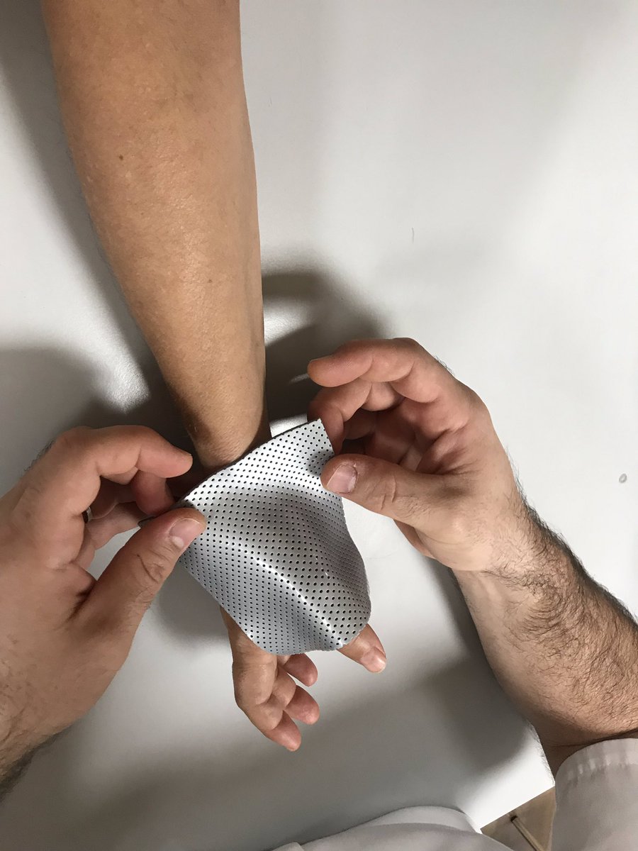 TgnHandClinic's tweet photo. Functional splint to avoid night pain and morning stifness in a patient with hemitrapeciectomy
#HandTherapy #HandFun #Biomechanics #Splint https://t.co/I63VMNb8o0