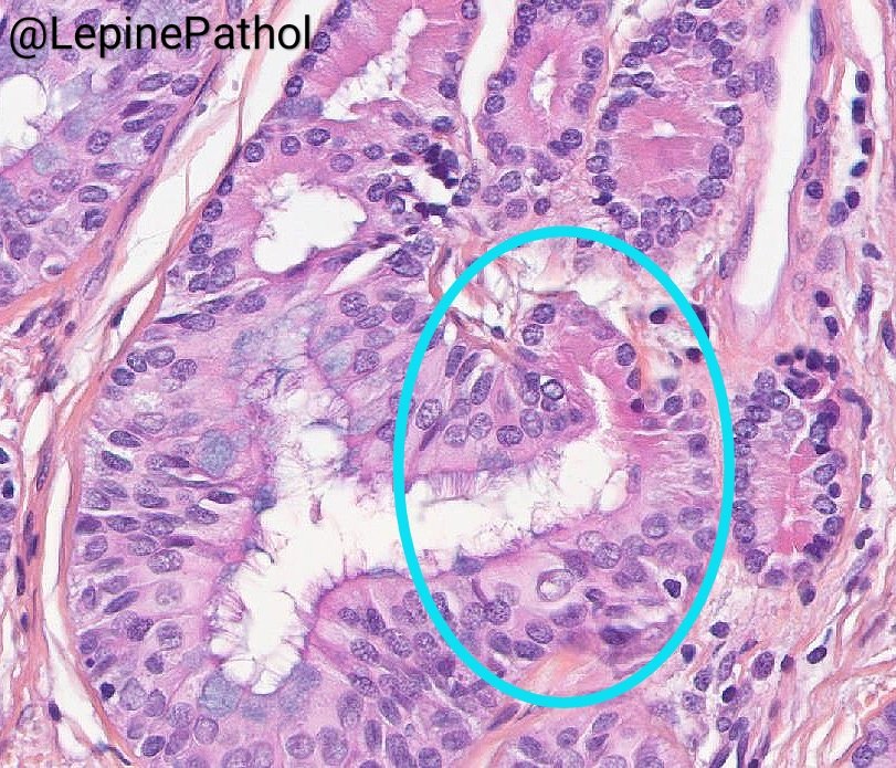 Charles Lépine, MD (@lepinepathol) on Twitter photo Respiratory epithelial adenomatoid hamartoma (REAH):
- polypoïd mass of the nasal cavity
- numerous glands lined by ciliated respiratory epithelium
- thickening of the basement membrane
- connection between respiratory epithelium and sero-mucinous glands
#ENTpath <a href="/CecileBadoualMD/">Cecile Badoual</a> Respiratory epithelial adenomatoid hamartoma (REAH):
- polypoïd mass of the nasal cavity
- numerous glands lined by ciliated respiratory epithelium
- thickening of the basement membrane
- connection between respiratory epithelium and sero-mucinous glands
#ENTpath <a href="/CecileBadoualMD/">Cecile Badoual</a>