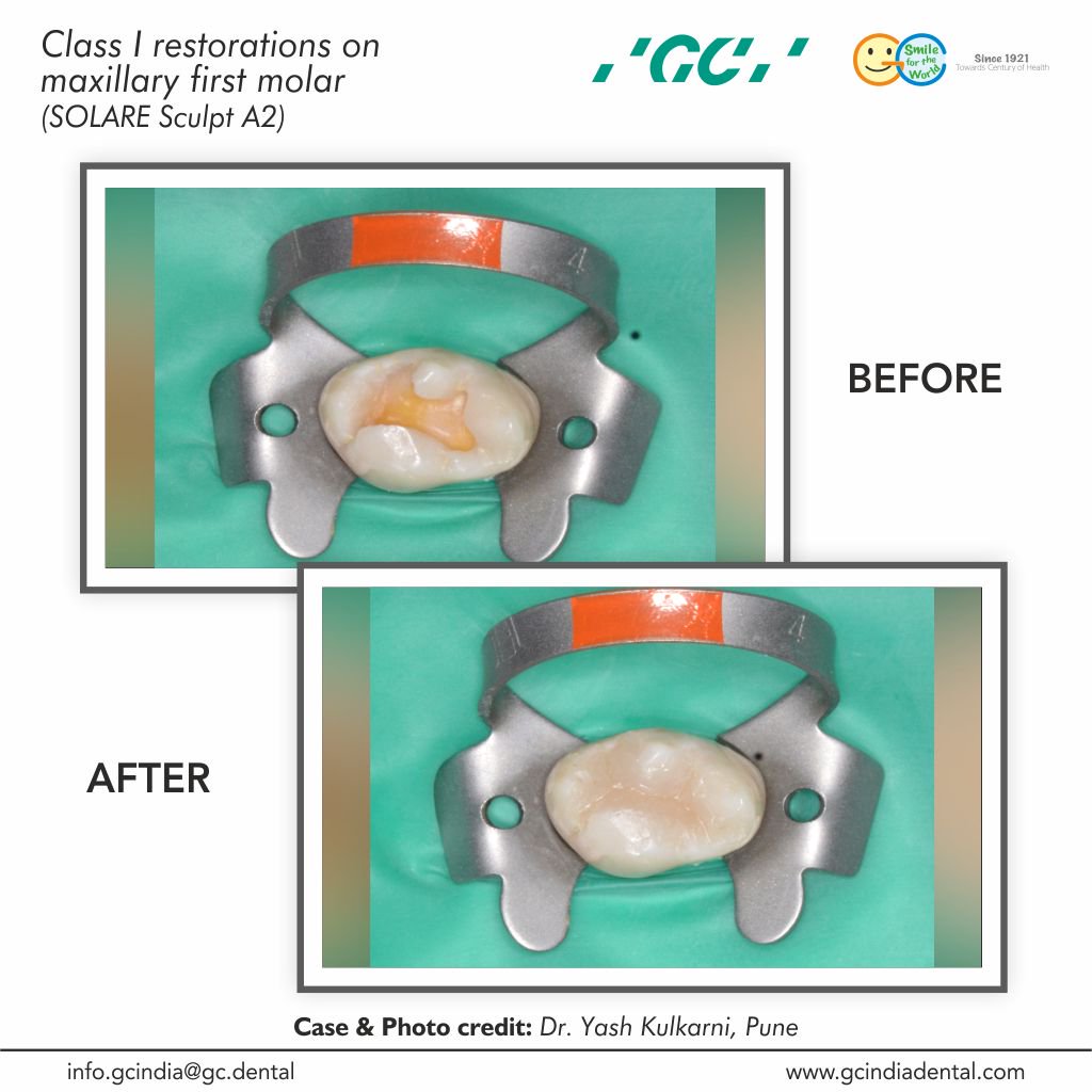 GCIndia_dental's tweet photo. GC Sculpt is a material that clinicians can place with ease for beautifully adapted, finished, fast, aesthetic and tough composite restorations.
https://t.co/O14QVa5c1y
Enquire: https://t.co/cYyi58G3lS
#GCSculpt #GCIndia #dental #DentalComposite #CompositeRestoration https://t.co/43LkpFdSjm