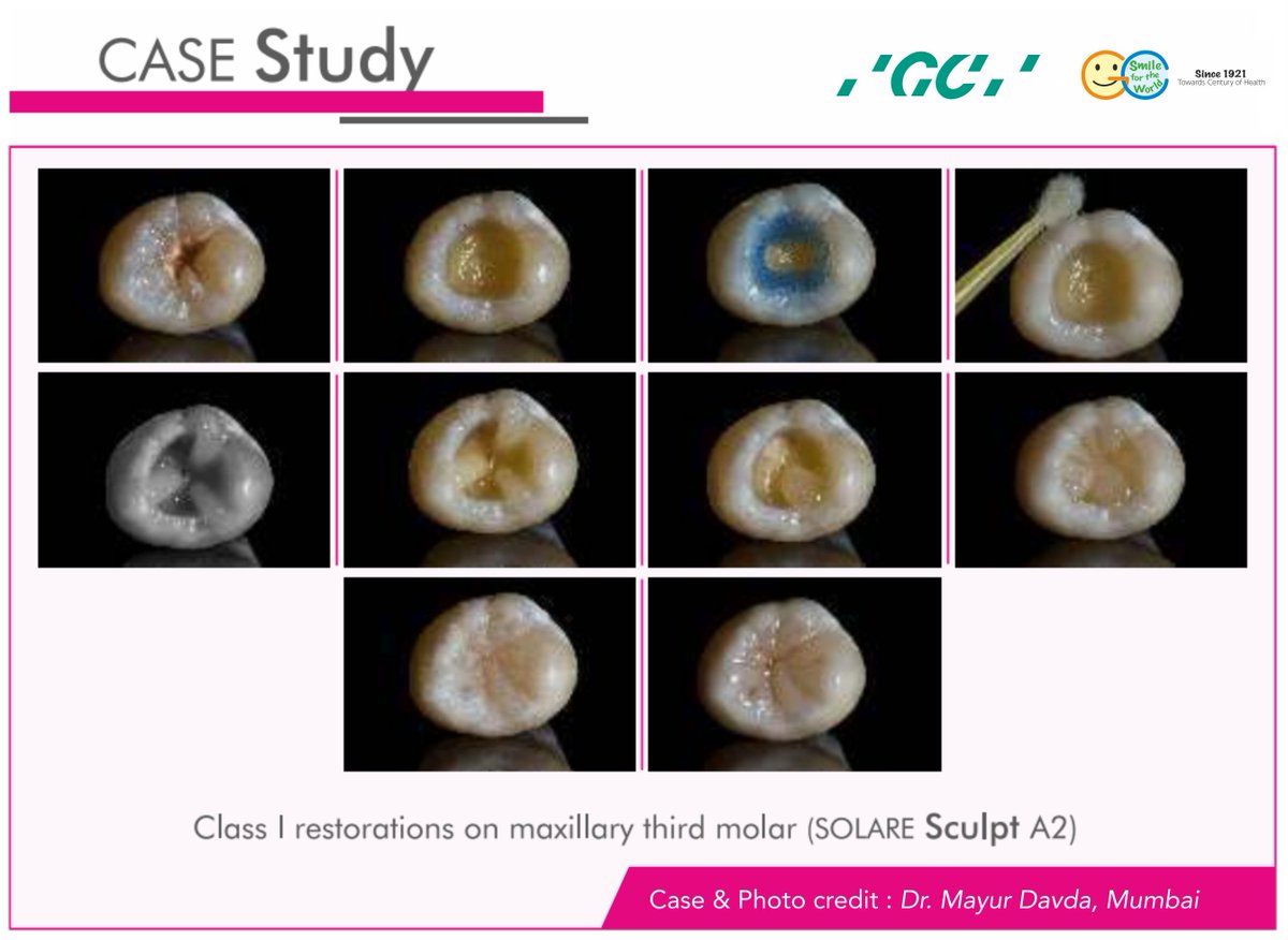 GCIndia_dental's tweet photo. GC Sculpt is a material that clinicians can place with ease for beautifully adapted, finished, fast, aesthetic and tough composite restorations.
https://t.co/O14QVa5c1y
Enquire: https://t.co/cYyi58G3lS
#GCSculpt #GCIndia #dental #DentalComposite #CompositeRestoration https://t.co/43LkpFdSjm