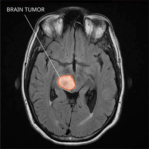 theNCI's tweet photo. A blood test called a #liquidbiopsy has shown promise for detecting genetic mutations in pediatric brain tumors: https://t.co/Xu80kO9IfZ #childhoodcancer https://t.co/3dWzqOwcvc