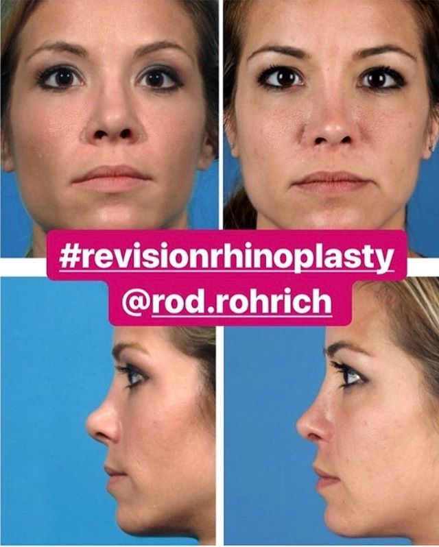 DrRodRohrich's tweet photo. #revisionrhinoplasty with #spreadergrafts and #septalextension graft @rod.rohrich restoration of #cosmetic appearance and #nasalfunction #naturallook #rhinoplasty #rhinoplastybeforeandafter #rhinoplastyexpert 👃🏽#lovingwhatido❤️ #tg4ps🙏 #givingback … https://t.co/6RvVe6rCY4 https://t.co/bM52gEE969