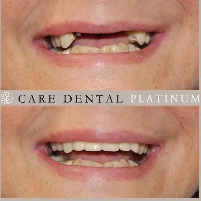 caredentalgroup's tweet image. ✨#DENTAL #IMPLANTS &amp;amp; #ZIRCONIA #BRIDGE ✨
 the patient was obviously delighted with the final result as we restored his natural smile and function and appearance of these vital upper front teeth. . .