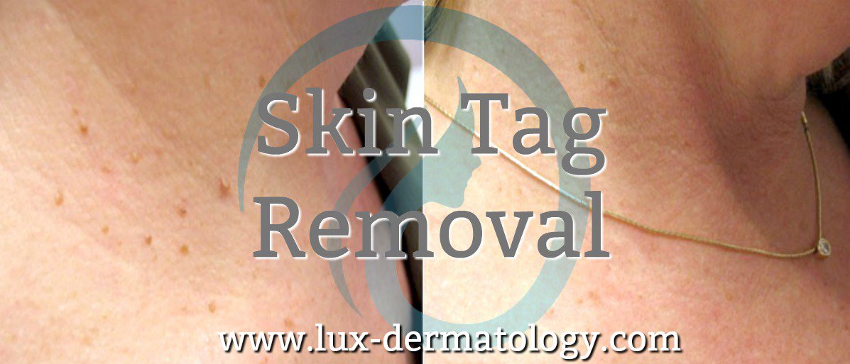 LuxSantaBarbara's tweet photo. Skin tags are a noxious growth on the skin that causes irritation and embarrassment. At Lux Dermatology, we can instantly improve the appearance of your skin with skin tag removal in Santa Barbara, CA.://lux-dermatology.com/dermatology-services/skin-tag-removal/ https://t.co/R6hHSz362h