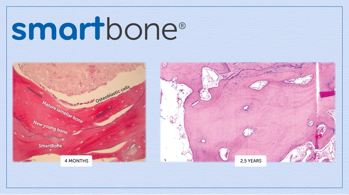 smartboneibi's tweet photo. The hybrid composition of #SmartBone® guarantees exceptional biomechanical properties and promotes an optimal and fast #osteointegration.
After grafting, #SmartBone® is totally resorbed and replaced by patient’s own bone within 1-2 years‼️
#swissexcellence 🇨🇭 https://t.co/dqC5R0mW4g