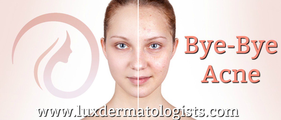 LuxDermVisalia's tweet photo. Don't let acne ruin your holidays! Are you embarrassed to take photos because of problematic skin? Let our team of providers get your skin clear for the holidays and beyond. >> https://t.co/g0OdLO7LGF https://t.co/DaD4kraU0K
