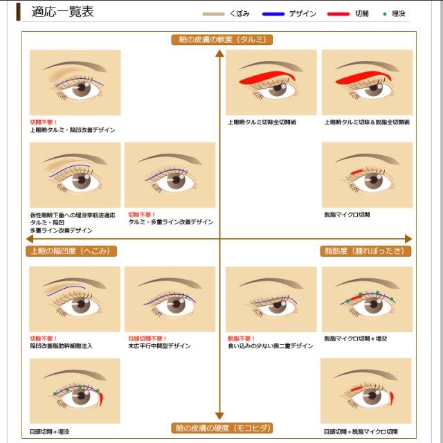Sk えくぼ形成 在 Twitter 上 二重 細かくいうと 瞼の種類って24分類あるらしい 平行 インアウト 末広の3通りで認識してたけど ここの一覧化されたやつめちゃわかりやすかった T Co Nob2dcjfcg Twitter