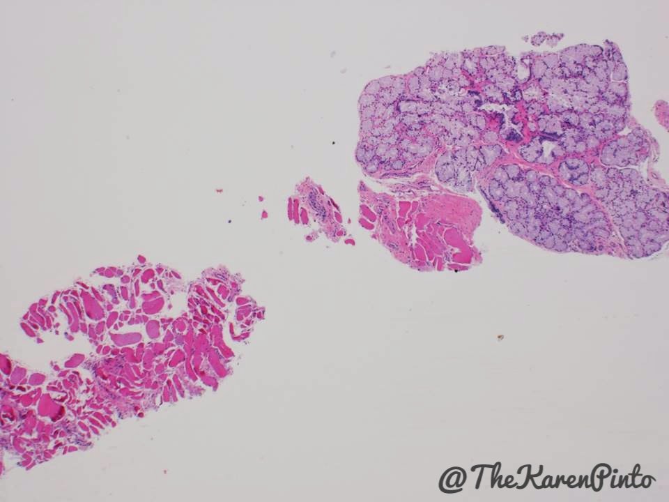 Karen Pinto DNB, FRCPath on Twitter "IHC Cowper's gland express PSA