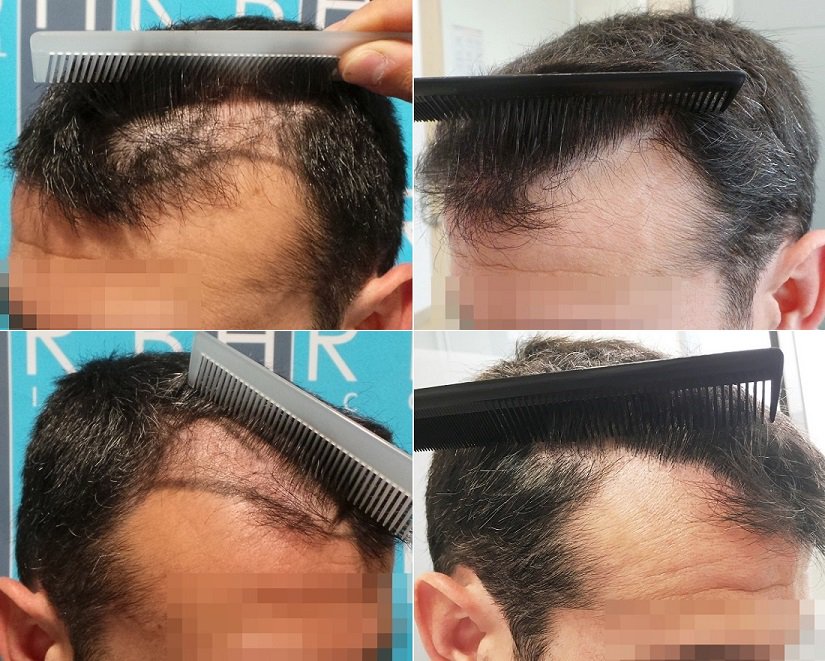 BHRClinic_ES's tweet photo. Los Dres. #Meyer y #Alcaide de @BHRclinicSPAIN emplearon 1349 folículos #FUE para rehacer las entradas de este paciente. Resultado 0-6 meses - #Alopecia #Calvicie #Pelo #Cabello #Trasplante #Injerto #FUE #Tira #Antesydespués #Bruselas #Málaga https://t.co/9nICtDC1aP