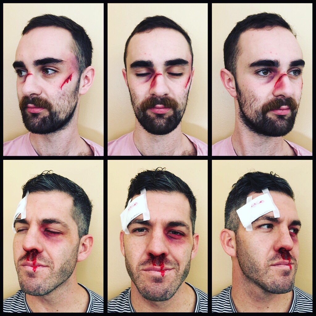 iamrobhensley's tweet photo. Took ‘beating a mug’ a little too literally! Having some #sfx fun today on the set of @EastSidersTV! Always have my @BenNyeMakeup #bruisewheel and #freshscab, and @TEMPTU #DuraPro palettes in my kit - just in case.
#makeup #makeupartist #mua #hairandmakeup #television #series https://t.co/nZXPlddYlX