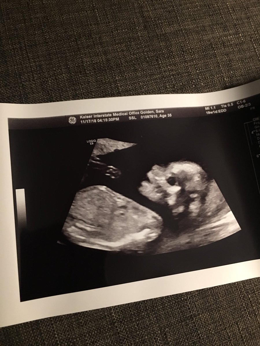 MurderDice's tweet image. Today has been CRAZY. Nearly zero time to tweet. I hope everyone is doing well! My day is going great. Here’s a creepy pic of my kid. 20 weeks. Half way there!