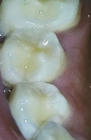 Michell42912829's tweet photo. @odontodents Buenas noches, foto del primer premolar inferior
Grupo. 1007 https://t.co/vBjGGgINgR