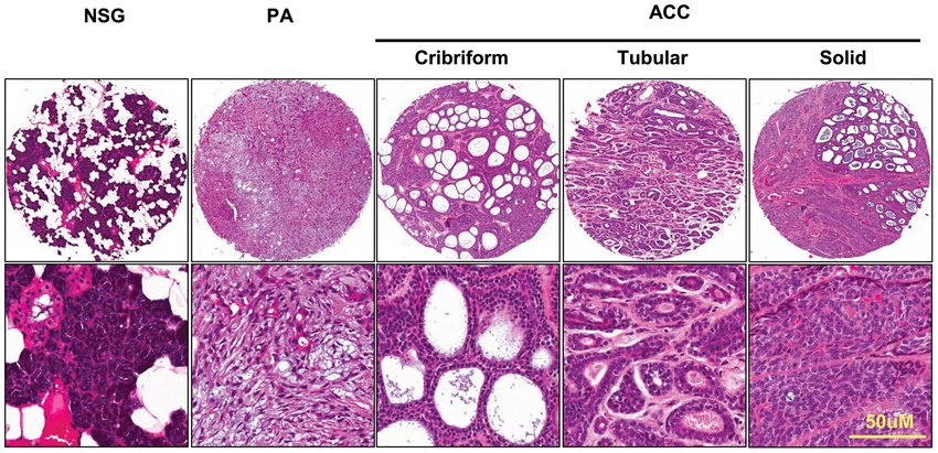 razand_s's tweet photo. Image of tissue array. The H&amp;E staining of normal salivary gland (NSG), pleomorphic adenoma (PA) and cribriform, tubular, and solid adenoid cystic carcinoma (AdCC).
PLGAs histology can be confused with (AdCC) and (PA)

 #made_easy #oralpath https://t.co/QzneX9hL2p