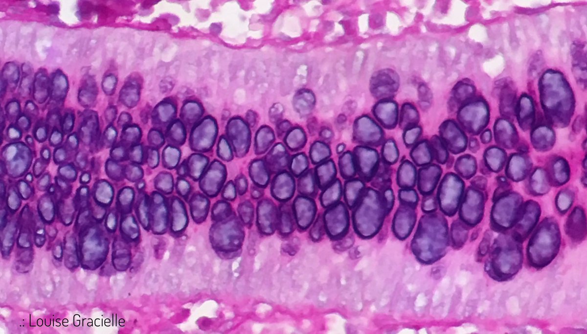 LouiseGracielle's tweet image. Gems of the day! 💎

#MicroscopicBeautyOfTheDay #ColonBiopsy #AlcianBluePAS #GobletCells #Pathology #GIpath