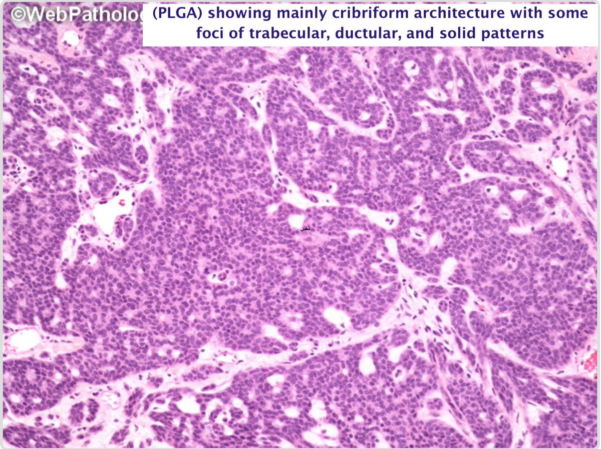 razand_s's tweet photo. Image of tissue array. The H&amp;E staining of normal salivary gland (NSG), pleomorphic adenoma (PA) and cribriform, tubular, and solid adenoid cystic carcinoma (AdCC).
PLGAs histology can be confused with (AdCC) and (PA)

 #made_easy #oralpath https://t.co/QzneX9hL2p