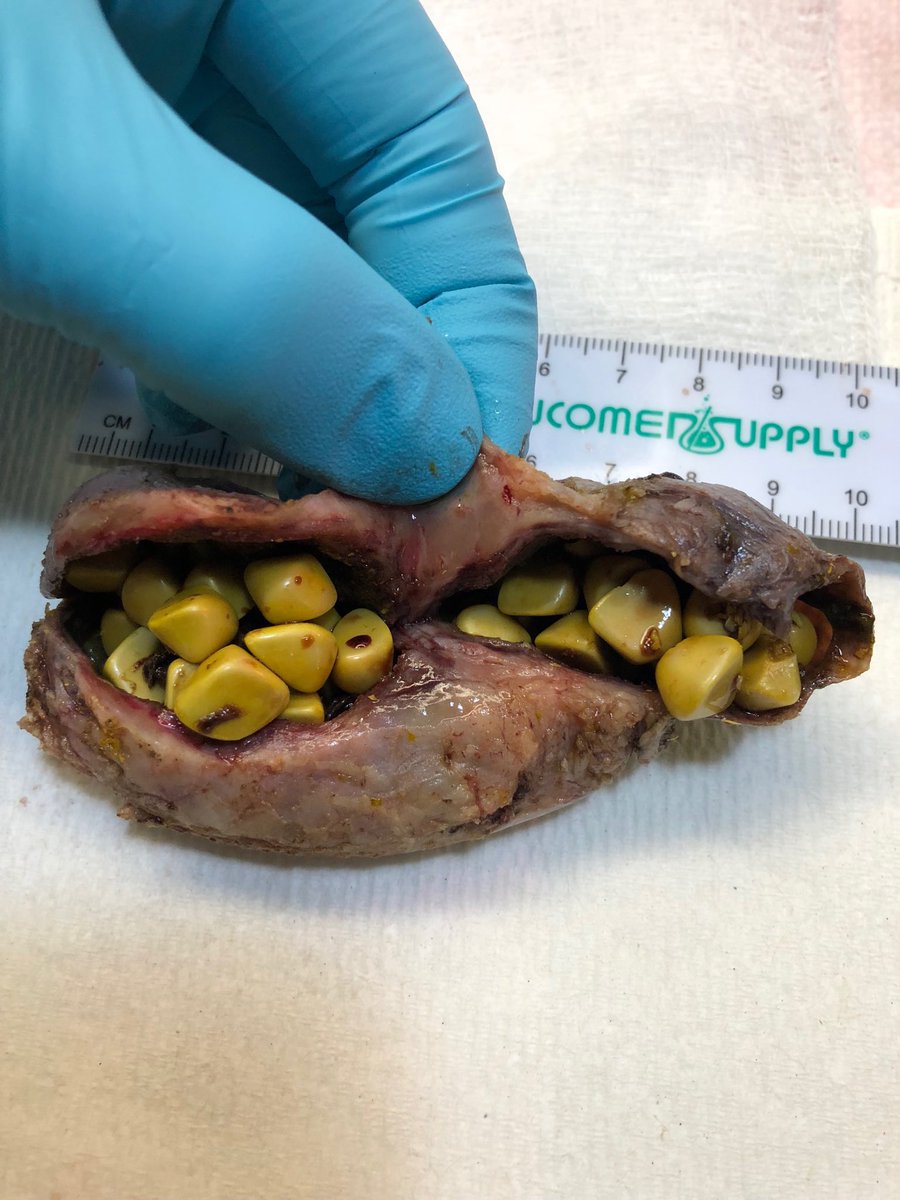 Missle's tweet image. Because who doesn’t want to see a cute gallbladder with faceted stones? #pathology #grosspath