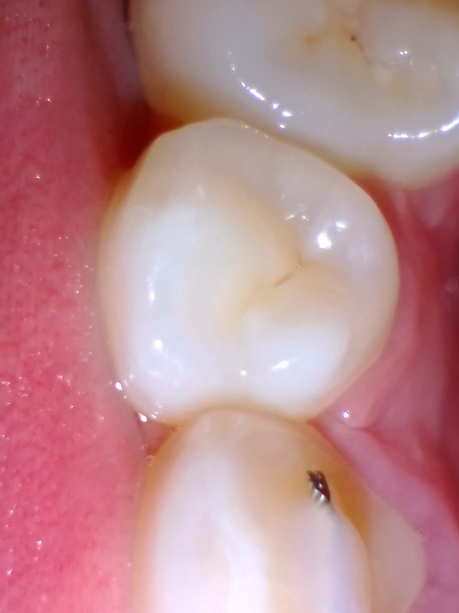 Evelyn54667220's tweet photo. @odontodents Segundo premolar "Y" https://t.co/eHTi7zHFmw