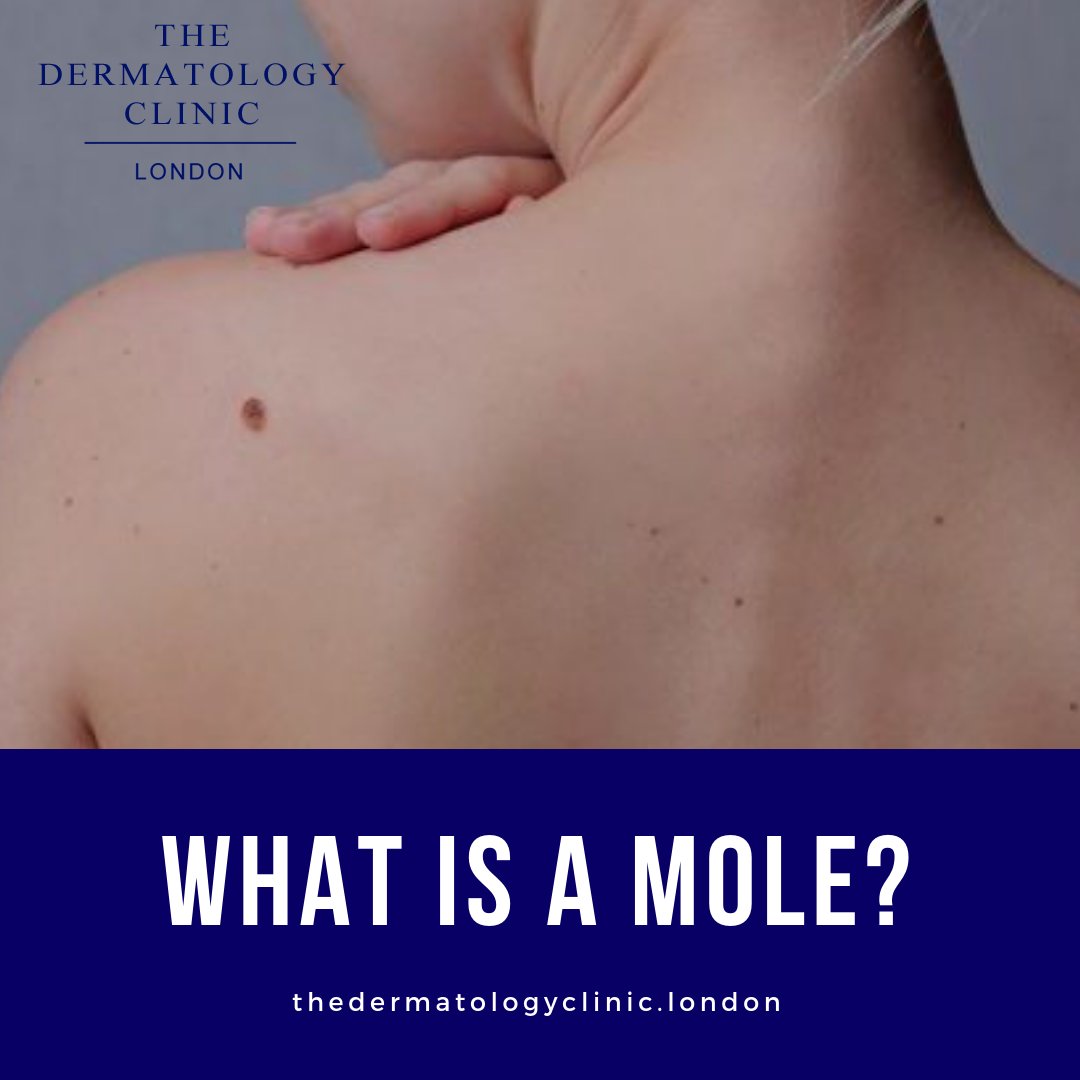 TheDermClinicUK's tweet photo. Most #moles are harmless, but a changing #mole can be a sign of #skincancer and should be reviewed by a #dermatologist. To have your moles checked, book an appointment with us at https://t.co/LuGBh0eXZT today.
#molecheck #molechecking #melanoma #skincancerawareness #meded https://t.co/ykgTCaITZu
