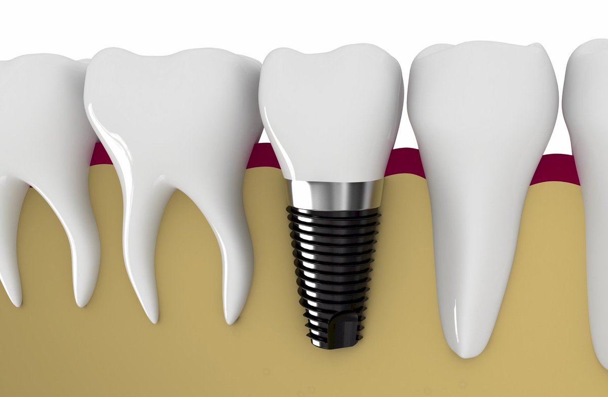 Dental Fact:
#Dentalimplants are the only dental restoration option that preserves and stimulates natural bone.
