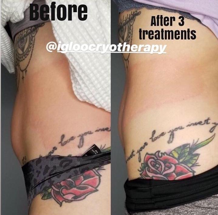 cryotherapyofwi's tweet photo. Have you heard about Cryo T Shock? It’s super effective at reducing cellulite, toning and tightening the skin, and addressing stubborn, localized fat. Want to try it free? https://t.co/3bgPiVV1dH https://t.co/oGchuMXuqv