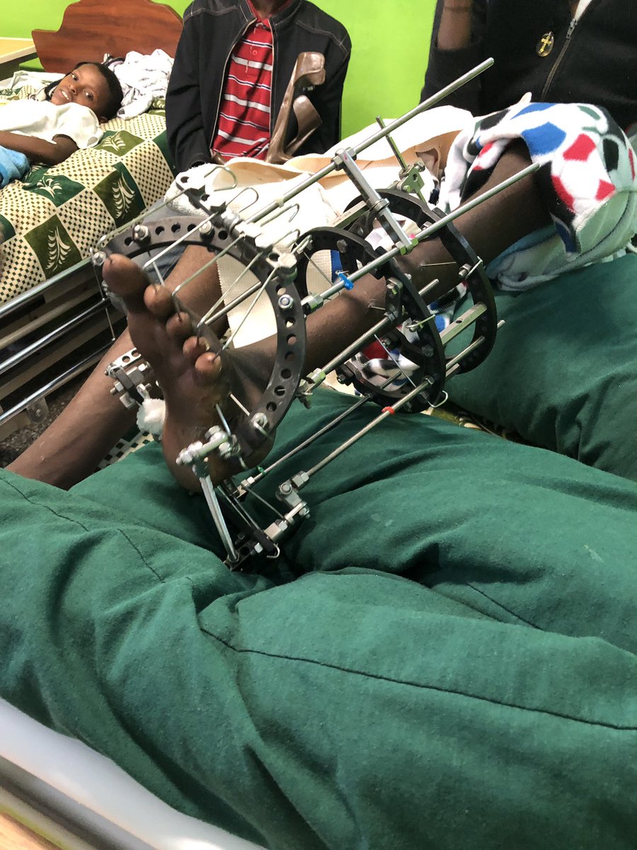 AIJackal's tweet photo. Amazing Work at #Cure Hospital Ethiopia #eurospine complex limb deformity, thanks Tim for hosting us @phileurospine for The Early Onset #Scoliosis seminar #iceos https://t.co/Svy0sKWIHx