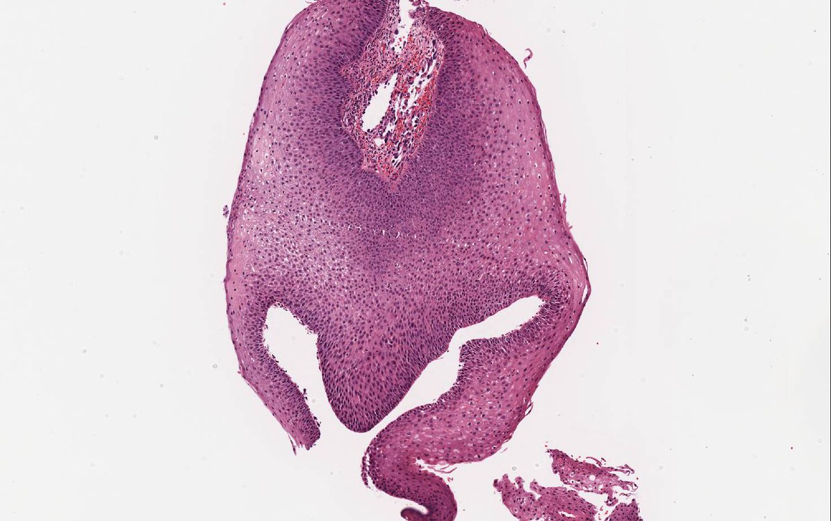 BinXu16's tweet image. Laryngeal biopsy...diagnosis? Other than helmet of magneto..... #ENTpath

@TheKarenPinto @DrAhmedKalebi @DrGeeONE @DrAldehyde @ariella8 @VijayPatho @ReneJaraM @renemaf @ReyPathology @kriyer68