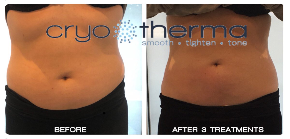 IceboxTherapy's tweet photo. CryoTherma @ Icebox
The new European technology that freezes fat & tightens skin.
#iceboxstudios #cryobeauty #freezefat #coldbeauty
https://t.co/Zv1hVqaFdj https://t.co/1MTGgqat44