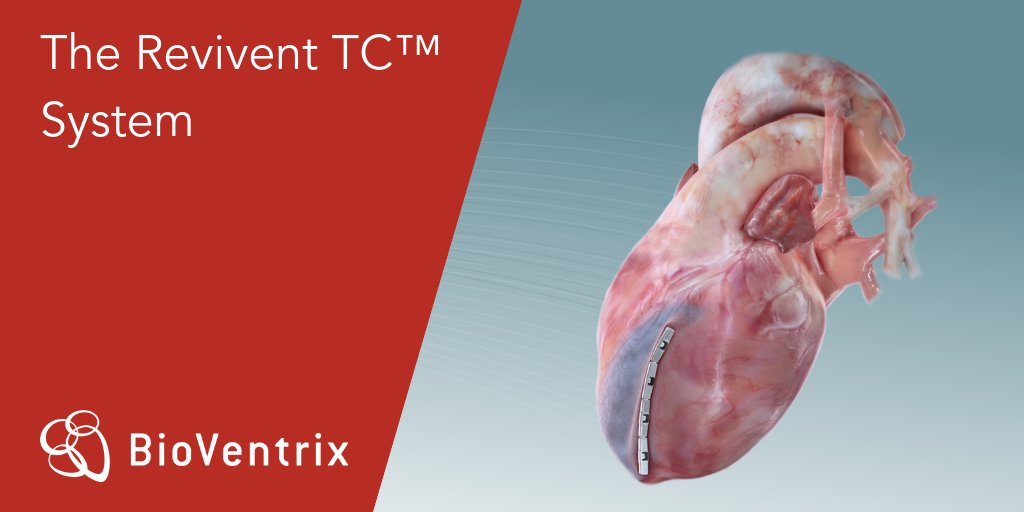 BioVentrixDE's tweet photo. Das Einpflanzen des #ReviventTC Systems mittels des #LIVE Verfahrens macht die Notwendigkeit eines invasiveren chirurgischen Eingriffs überflüssig. Mehr über diese neue Behandlung des #Herzversagens unter https://t.co/Zbf7oG6iCV https://t.co/h198cSoVu1