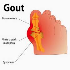 PEMFGUY's tweet photo. How PEMF Therapy works to heal Gout. https://t.co/BE8WTRfj0y 
#healing #pemf #gout #chronicillness #pain #chiropractic https://t.co/BfrGVVakhD