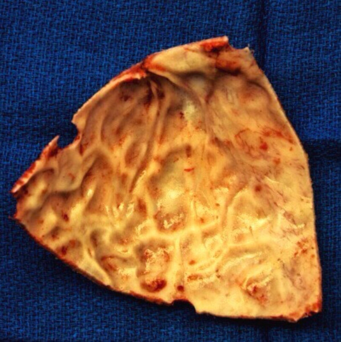 This is what pressure looks like. When this skull bone was removed for craniosynostosis, our team at the Cleft and Craniofacial Center at UMPC Children’s Hospital immediately knew we were doing the right thing by operating. 

instagram.com/p/BqNUB3egauc/

#craniosynostosis #skull