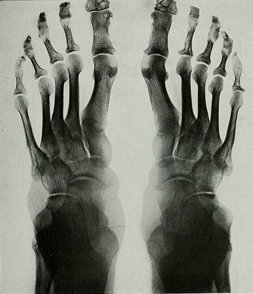 Foot Shape Ancestry: What Your Toes Can Tell You bit.ly/2Dq9u38 #genealogy #familyhistory #ancestry https://t.co/AAx7rVUmmQ