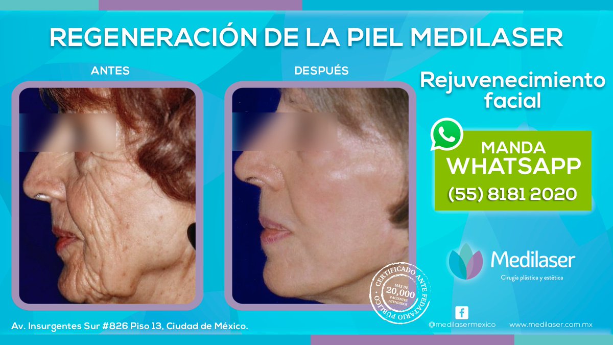drfermoli's tweet photo. Lo habitual es esperarse al menos dos meses para poder exponernos al #SOL de manera prolongada ante una #cicatriz después de una #CirugíaEstetica y hasta un año si quieres asegurarte de que no quedará marca. https://t.co/1vbINFd9eF