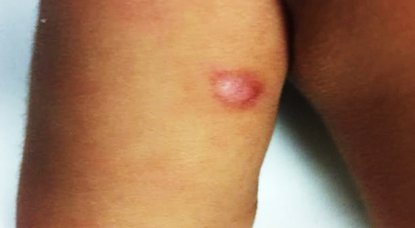 luishcruzc's tweet image. Smooth Muscle Hamartoma 👶👶🔬✏️
✔️Rare
✔️Congenital lesion
✔️flesh colored plaque
✔️Composed of randomly arranged bundles of mature smooth muscle in the dermis
✔️overlying epidermis may show hyperkeratosis, acanthosis and hyperpigmentation
#pathology #dermpath #PediPath