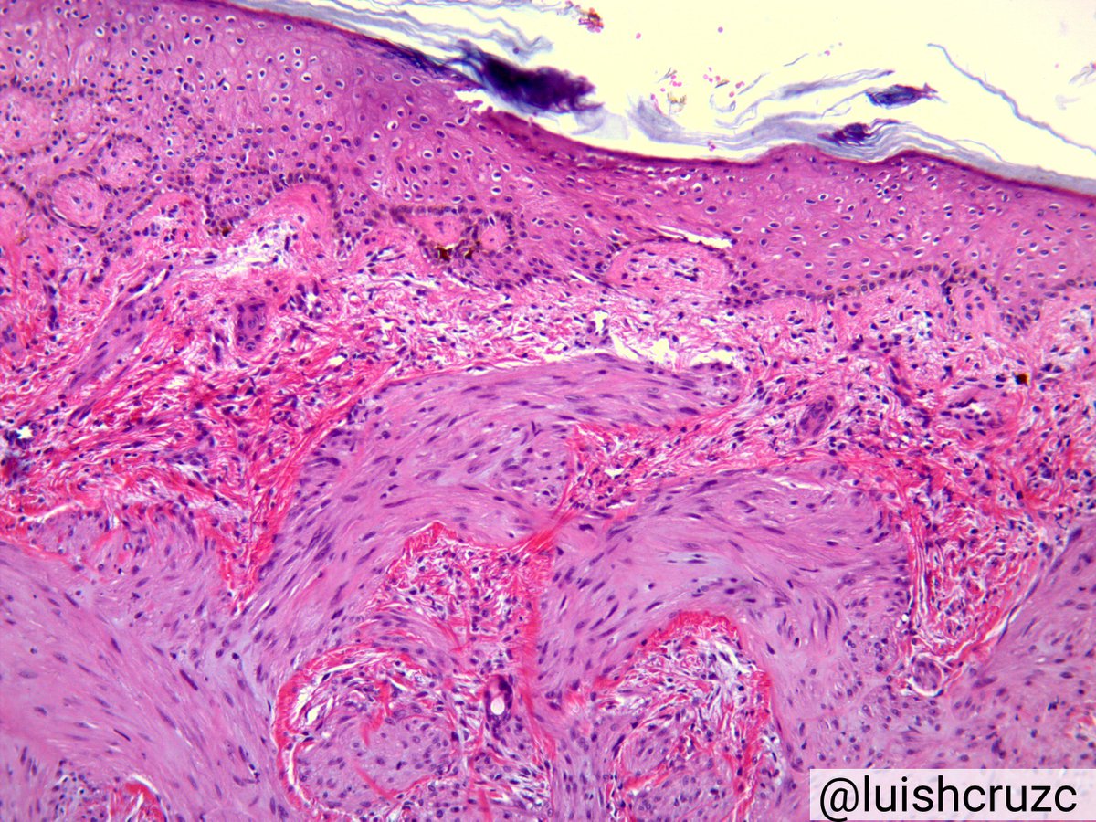 luishcruzc's tweet image. Smooth Muscle Hamartoma 👶👶🔬✏️
✔️Rare
✔️Congenital lesion
✔️flesh colored plaque
✔️Composed of randomly arranged bundles of mature smooth muscle in the dermis
✔️overlying epidermis may show hyperkeratosis, acanthosis and hyperpigmentation
#pathology #dermpath #PediPath