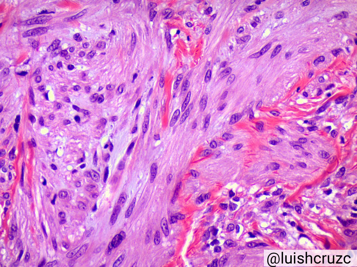 luishcruzc's tweet image. Smooth Muscle Hamartoma 👶👶🔬✏️
✔️Rare
✔️Congenital lesion
✔️flesh colored plaque
✔️Composed of randomly arranged bundles of mature smooth muscle in the dermis
✔️overlying epidermis may show hyperkeratosis, acanthosis and hyperpigmentation
#pathology #dermpath #PediPath